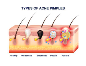 Types of acne pimple lesions